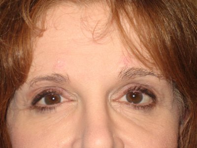 Forehead lift surgery on Long Island
