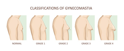 Gynecomastia consultation in New York