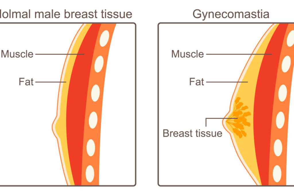 Gynecomastia Treatment in New York