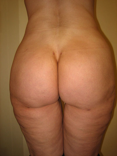 Buttock Augmentation Photos