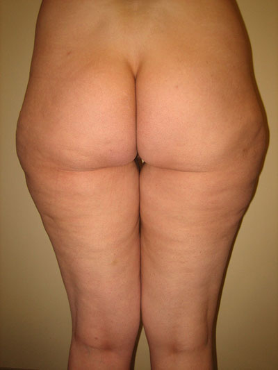 Buttock Augmentation Photos